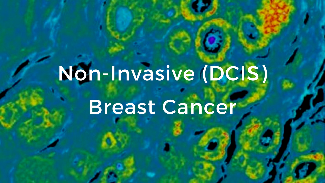 Invasive Ductal Carcinoma: What Is It, Risk Factors,, 59% OFF