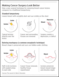 Oncoplastic Breast Surgery: The Breast Cancer School For Patients