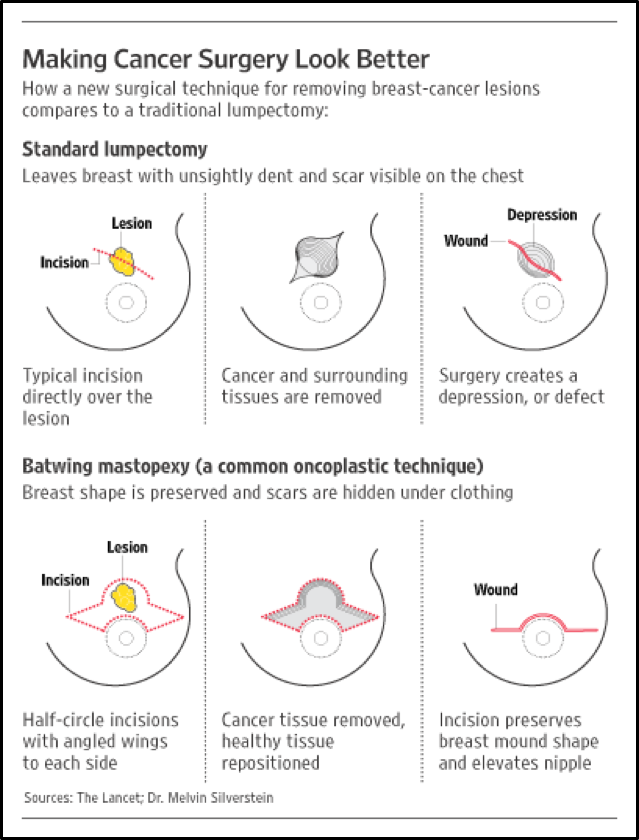 ONCOPLASTIC BREAST CONSERVING SURGERY - SURGICAL TECHNIQUES